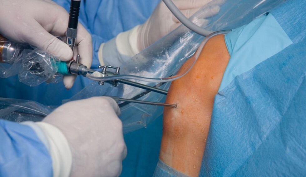 Arthroscopic knee surgery