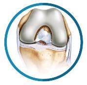 bear-distal-avulsion